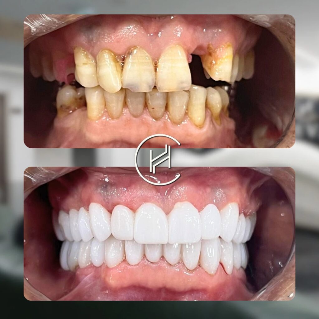 28 Zirconium Crown treatment before after result at heva clinic turkey 28 Zirconium Crown treatment before after result at heva clinic turkey