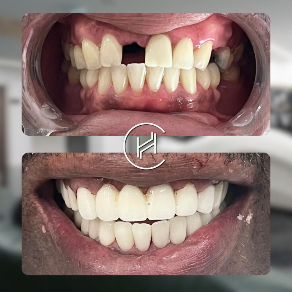 28 Zirconium Crowns at heva clinic turkey 28 Zirconium Crowns at heva clinic turkey