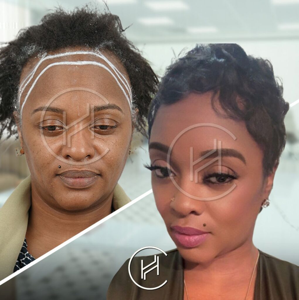 2900-grafts-female-afro-hair-transplant-before-after 2900 grafts female afro hair transplant before after