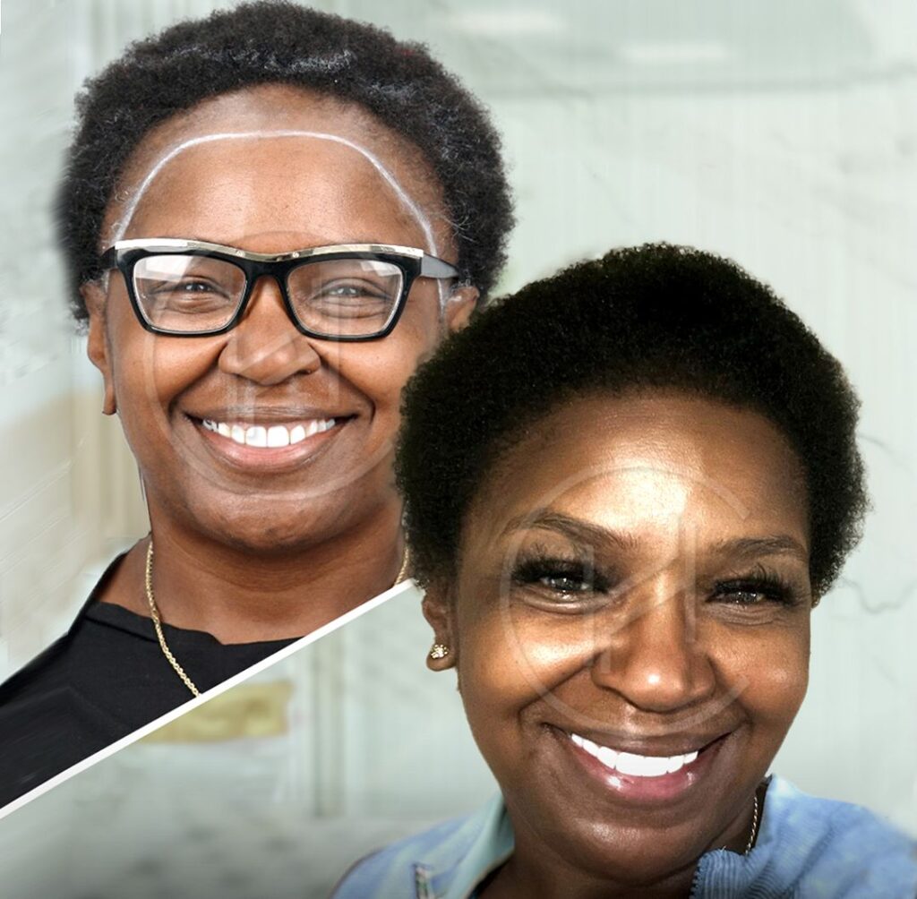 3018-graft-female-hair-transplant-before-after-result 3018 graft female hair transplant before after result