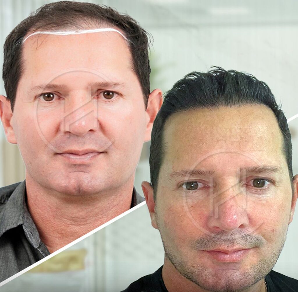 4500-graft-hair-transplant-one-session-before-and-after-photo 4500 graft hair transplant one session before and after photo
