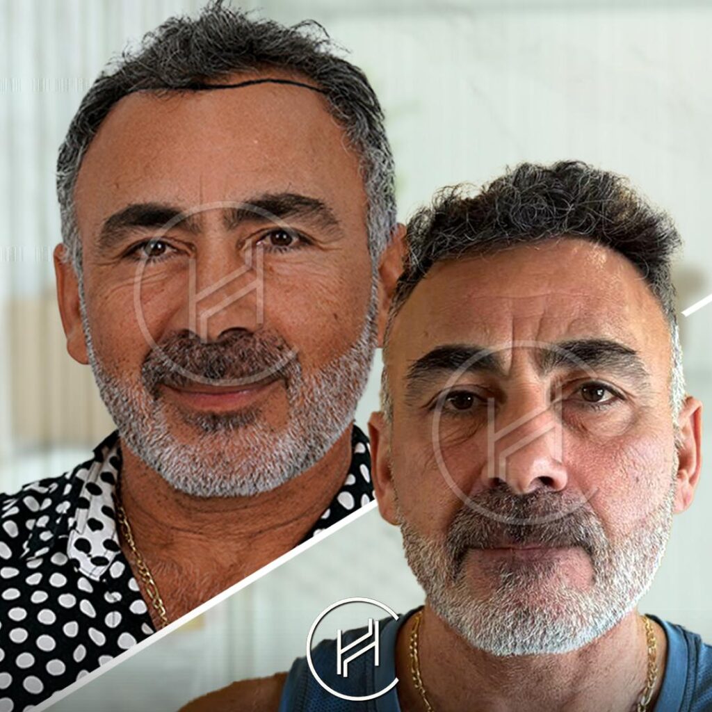 4800-grafts-fue-hair-transplant-heva-clinic-istanbul-turkey 4800 grafts fue hair transplant heva clinic istanbul turkey