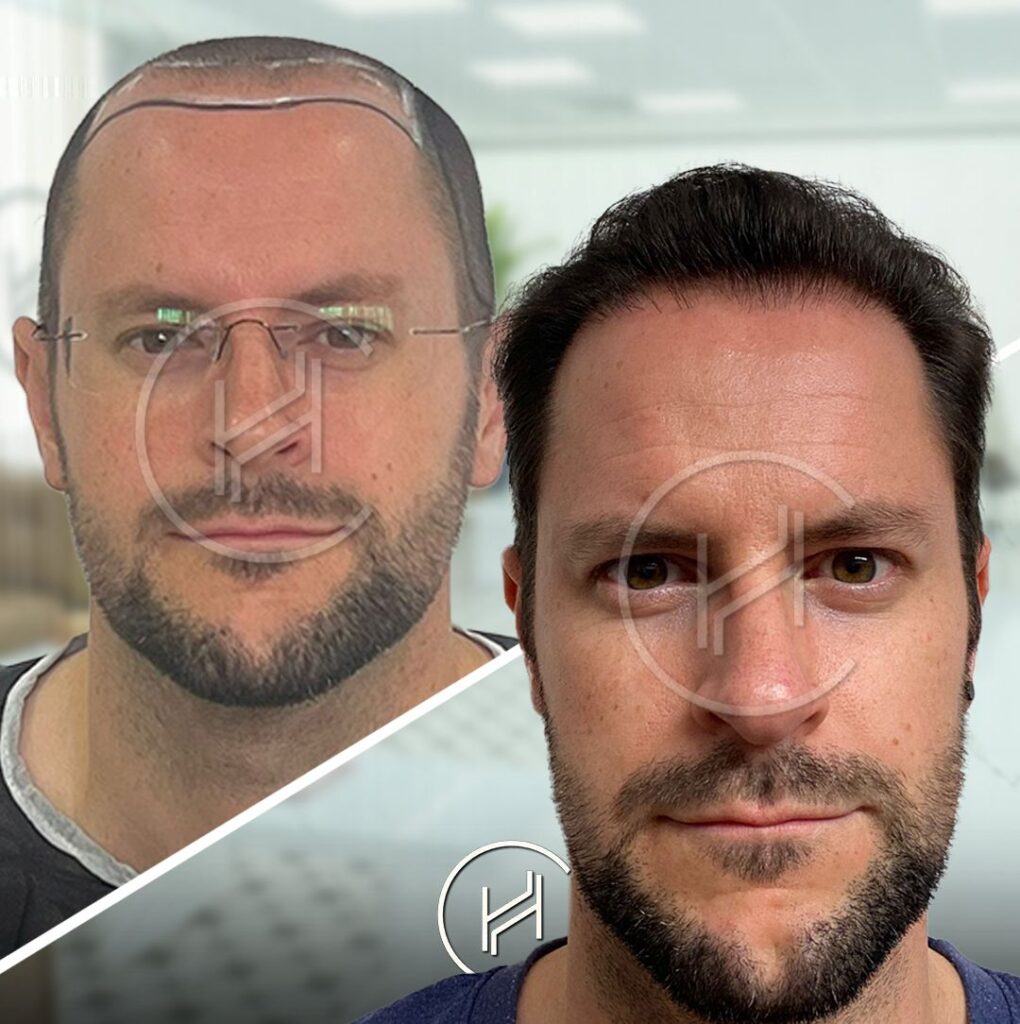5000-grafts-crown-hairline-hair-transplant-before-after 5000 grafts crown hairline hair transplant before after