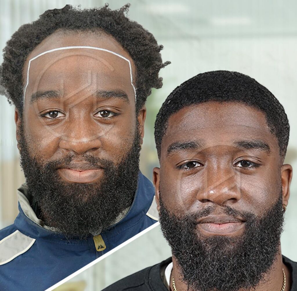7-month-4500-grafts-afro-hair-transplant-before-after-result 7 month 4500 grafts afro hair transplant before after result