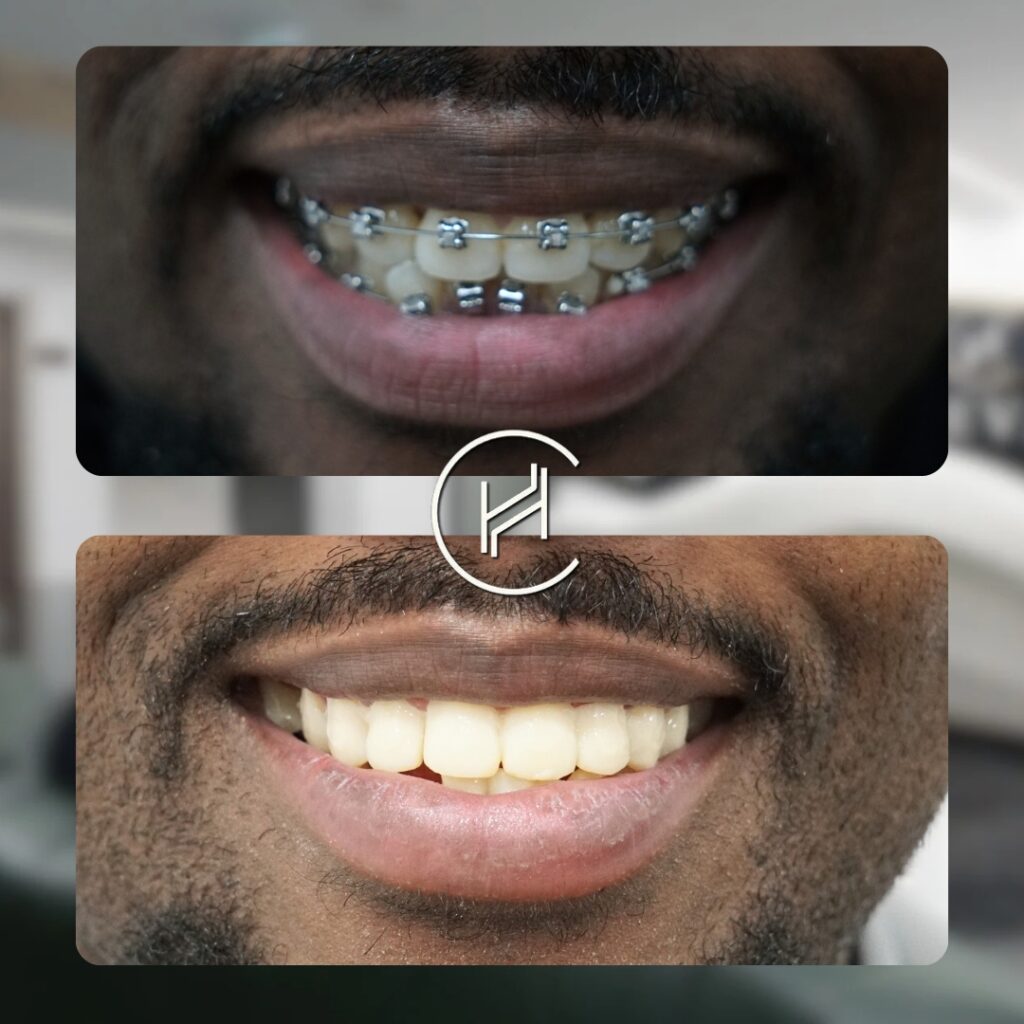 Zirconium Crown dental result heva clinic istanbul Zirconium Crown dental result heva clinic istanbul