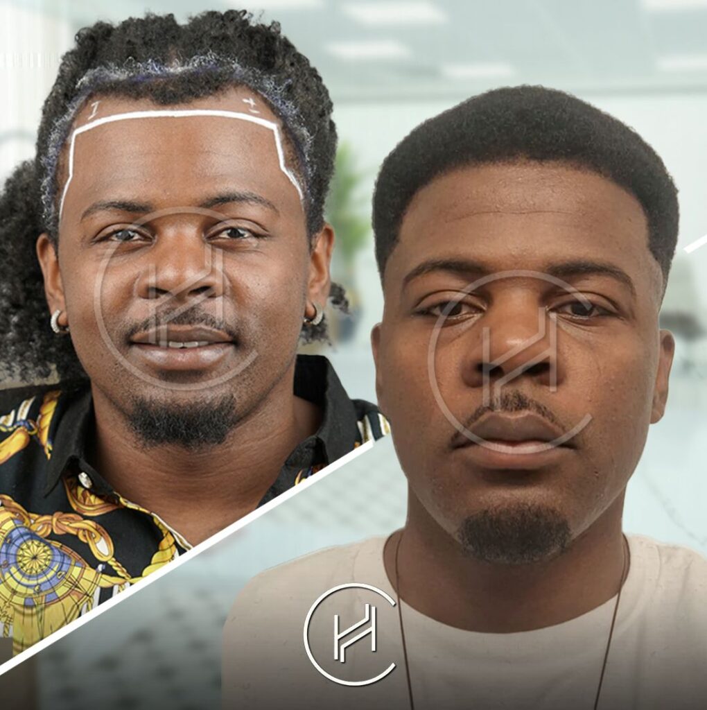 afro-hairline-restoration-before-and-after-heva-clinic-istanbul-turkey afro hairline restoration before and after heva clinic istanbul turkey