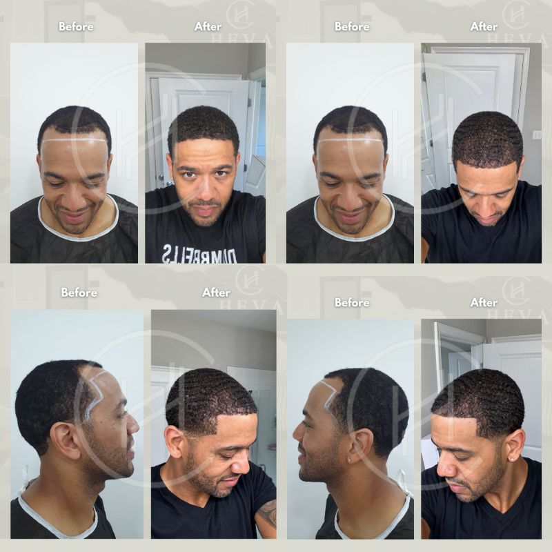 afro hairline transplant result before after four angles afro hairline transplant result before after four angles