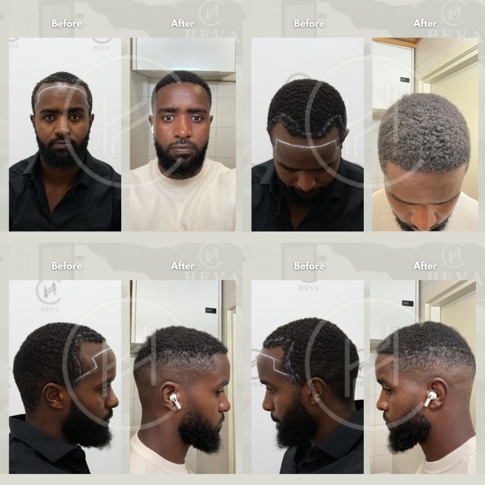 black man hair transplant before and after afro hairline four angles black man hair transplant before and after afro hairline four angles