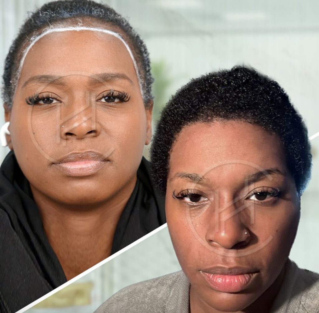 black-woman-hair-transplant-before-and-after-result black woman hair transplant before and after result