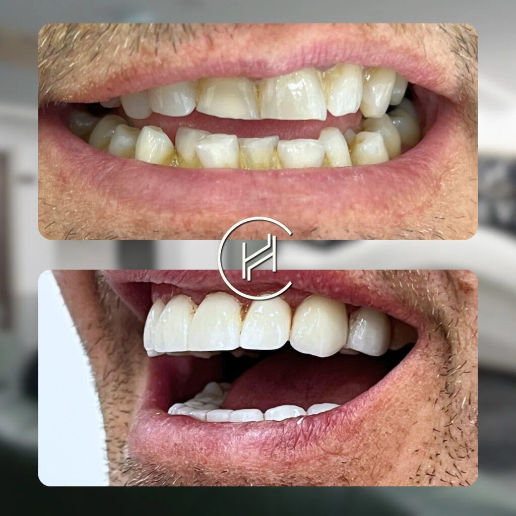 curettage and 24 zirconium dental procedure at heva clinic curettage and 24 zirconium dental procedure at heva clinic