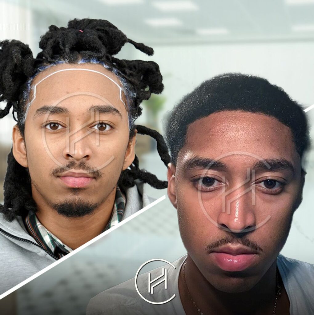 dreadlock-hair-transplant-before-and-after-2500-grafts dreadlock-hair-transplant-before-and-after-2500-grafts