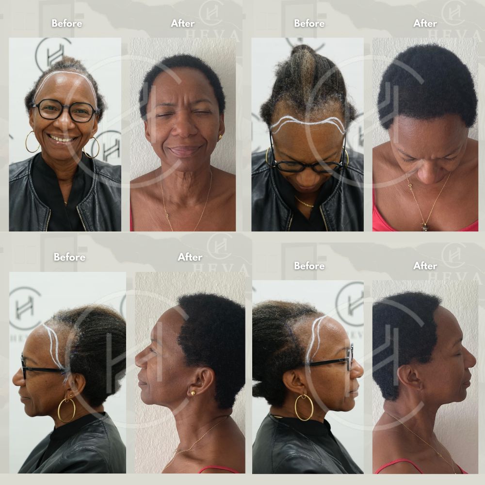 female afro hair transplant before and after result four angles female afro hair transplant before and after result four angles