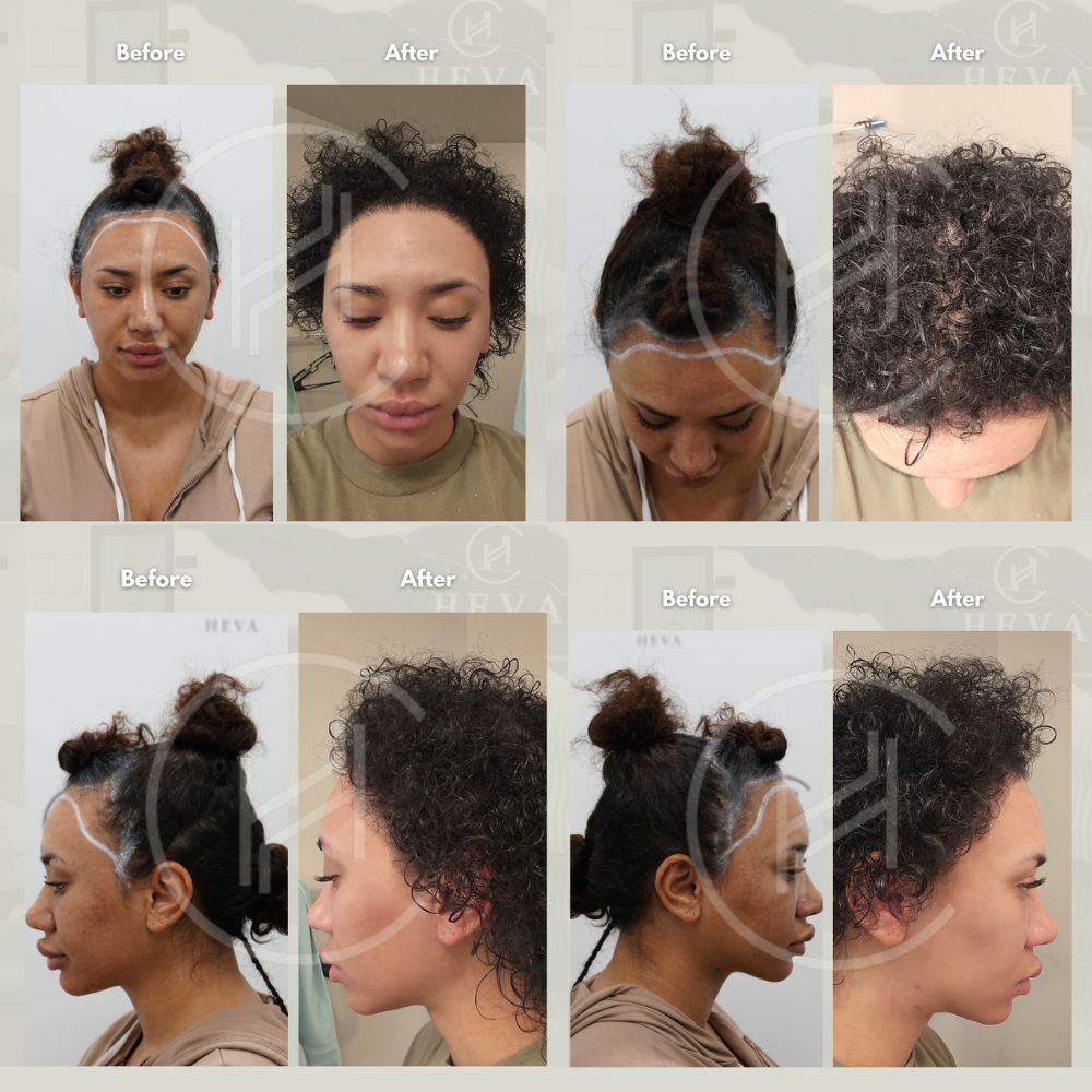 female afro hair transplant before and after result four angles