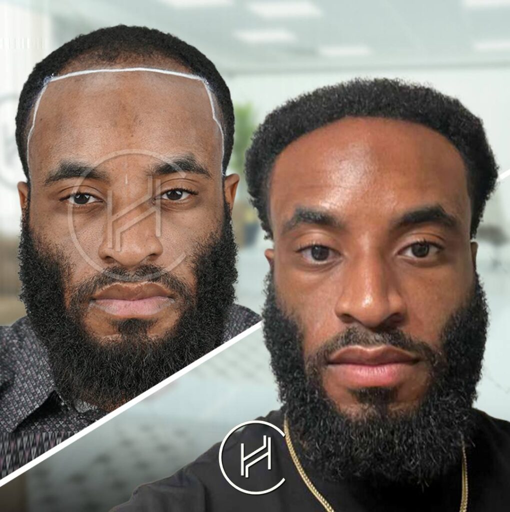 norwood-3-hair-loss-4000-grafts-afro-hairline-transplant-before-after norwood 3 hair loss 4000 grafts afro hairline transplant before after