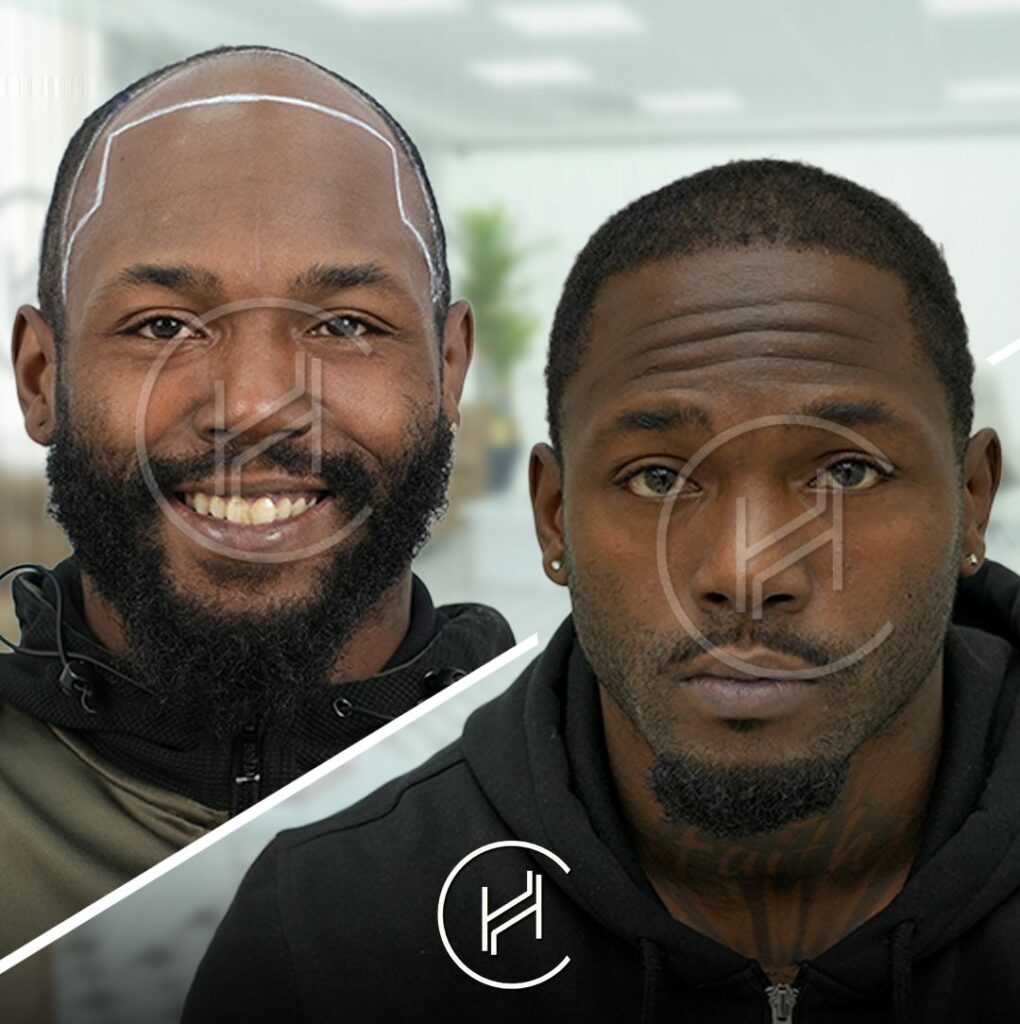 ufc-fighter-darrius-flowers-3500-graft-afro-hair-transplant-result ufc fighter darrius flowers 3500 graft afro hair transplant result