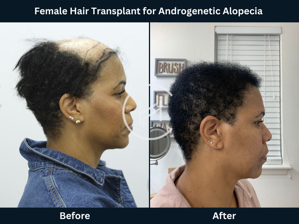 Female Hair Transplant for Androgenetic Alopecia Before and After Side