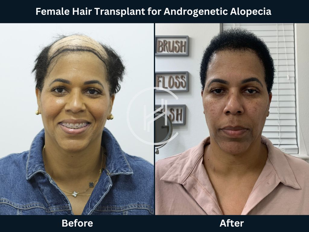 Female Hair Transplant for Androgenetic Alopecia Before and After