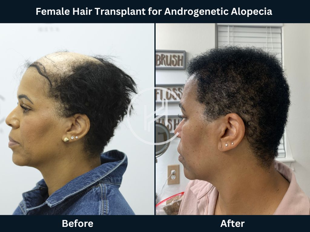 Female Hair Transplant for Androgenetic Alopecia (Female Pattern Hair Loss) Result Side