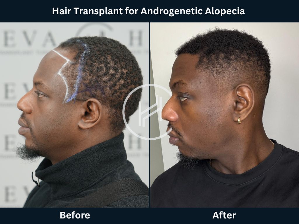Afro Hair Transplant for Androgenetic Alopecia Result Before After