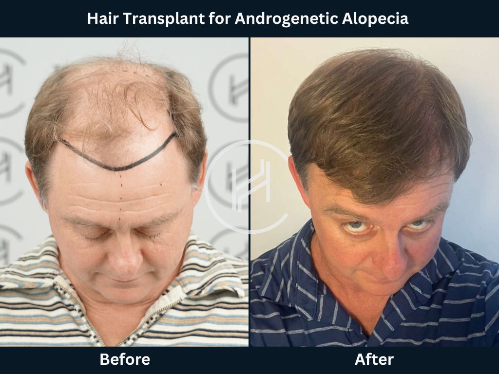 Male Pattern Hair Loss (Androgenetic Alopecia) Hair Transplant Before and After Photo