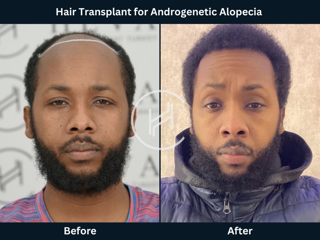 Male Hair Transplant for Androgenetic Alopecia Before After Photo