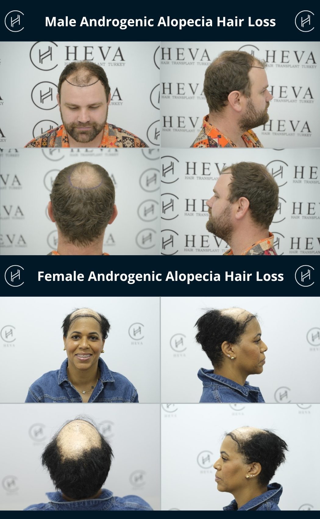 Male and Female Androgenic Alopecia Hair Loss Examples